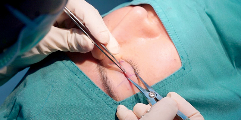 Bảng giá cắt mí mới nhất 2026
