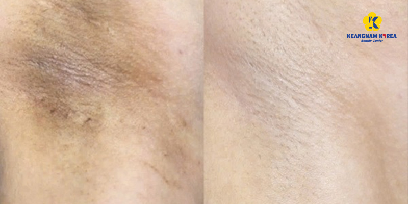 cách trị thâm nách