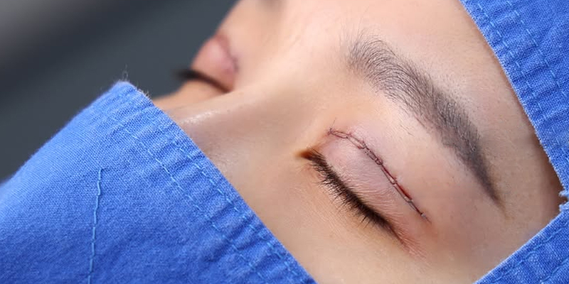 Cách chườm nóng sau khi cắt mí và các phương pháp giúp mắt nhanh lành 3 Cách chườm nóng sau khi cắt mí