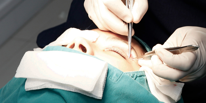 Cách chườm nóng sau khi cắt mí và các phương pháp giúp mắt nhanh lành 2 Cách chườm nóng sau khi cắt mí