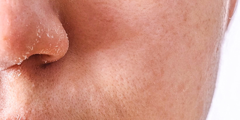 cách dưỡng ẩm cho da mặt bị khô