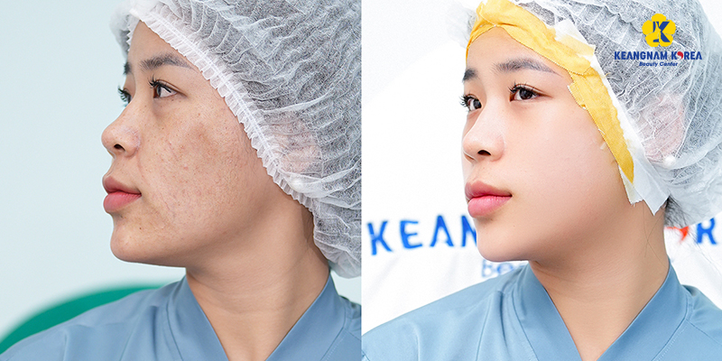 cách dưỡng ẩm cho da mặt bị khô