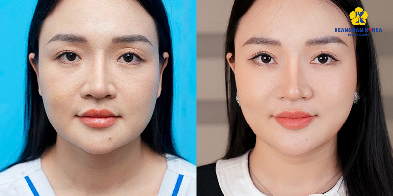 cách trị mỡ mắt