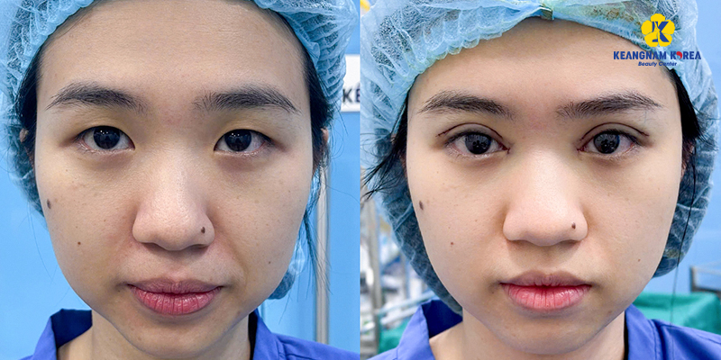 Cách khắc phục cắt mí bị sưng phù nề để mắt hồi phục nhanh và đẹp tự nhiên 3 Cách khắc phục cắt mí bị sưng phù nề