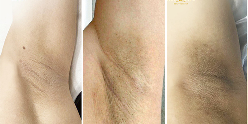 spa trị thâm nách