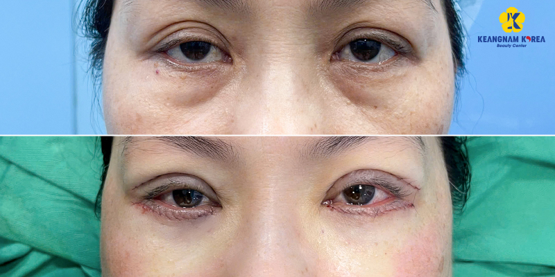 Cắt mí dưới có để lại sẹo không?