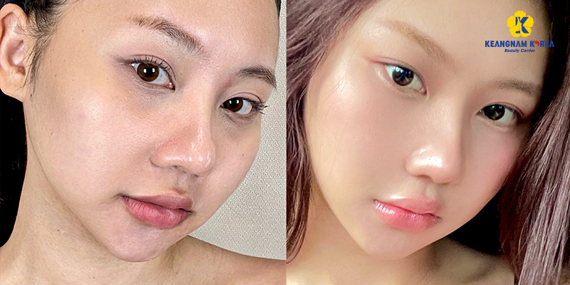 fusion meso là gì