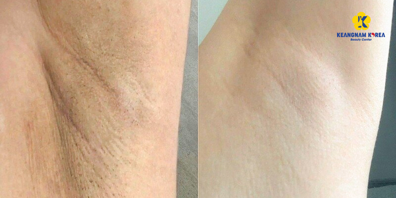 spa trị thâm nách