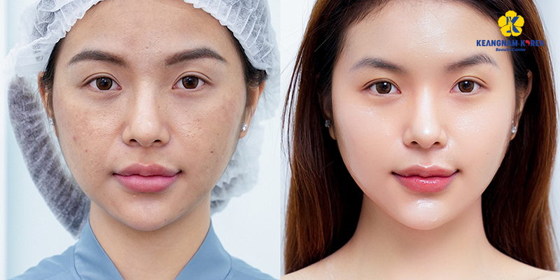 Glow Mesotherapy: What It Costs and How to Fit a Course Into a Trip 2 Glow Mesotherapy cost vietnam