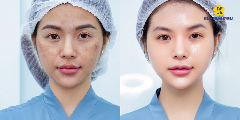 cách dưỡng ẩm cho da mặt bị khô