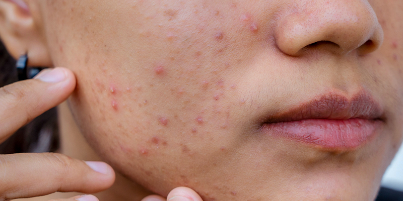 Meso fusion có tác dụng gì