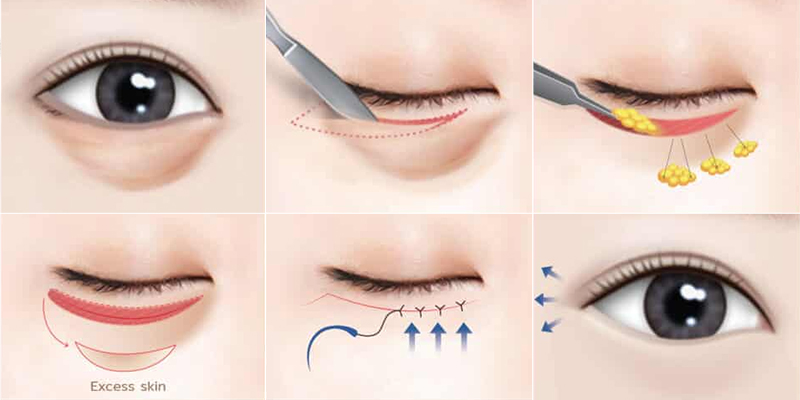 Cắt mí dưới có hết nhăn không