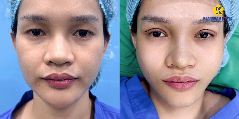 Nguyên nhân gây mỡ mí mắt trên là gì? Lấy mỡ mí mắt trên bao nhiêu tiền? 2 Nguyên nhân gây mỡ mí mắt trên