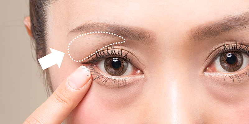 Nguyên nhân gây mỡ mí mắt trên là gì? Lấy mỡ mí mắt trên bao nhiêu tiền? 1 Nguyên nhân gây mỡ mí mắt trên