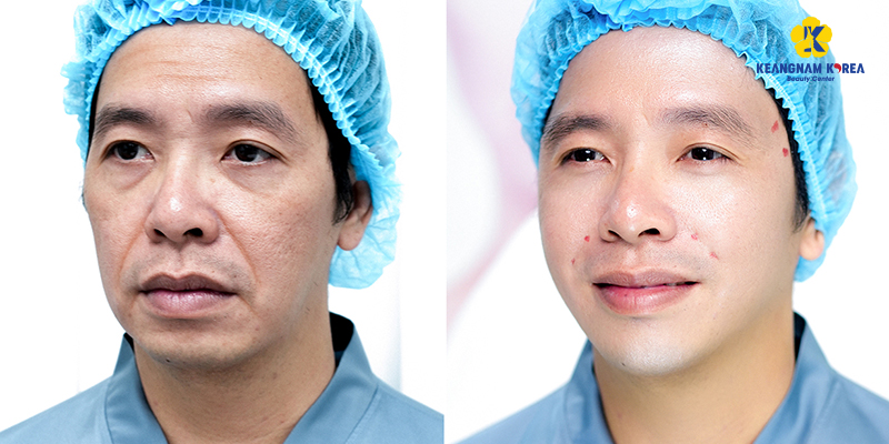 phương pháp xóa nếp nhăn vùng mắt