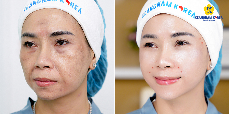 phương pháp xóa nếp nhăn vùng mắt