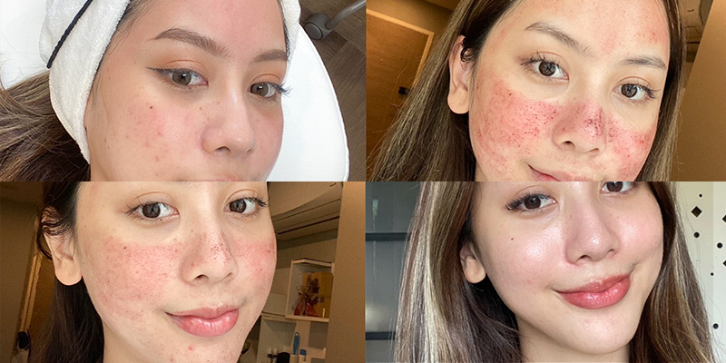 Tiêm Meso trắng da giá bao nhiêu? Hiệu quả có thật sự tốt như lời đồn? 3 Tiêm Meso trắng da giá bao nhiêu?