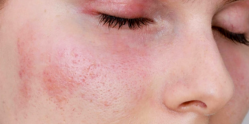 sau khi bắn laser có được rửa mặt không