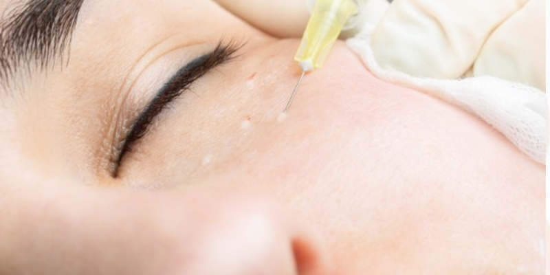 Tiêm meso bao lâu hết sưng?