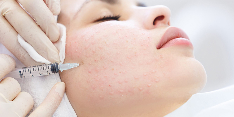 Tiêm meso bao lâu hết sưng?