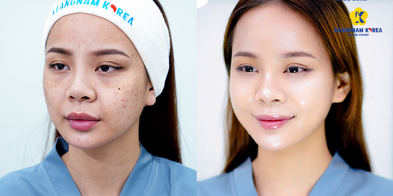 Tiêm meso căng bóng giá bao nhiêu? 5 Tiêm meso căng bóng giá bao nhiêu