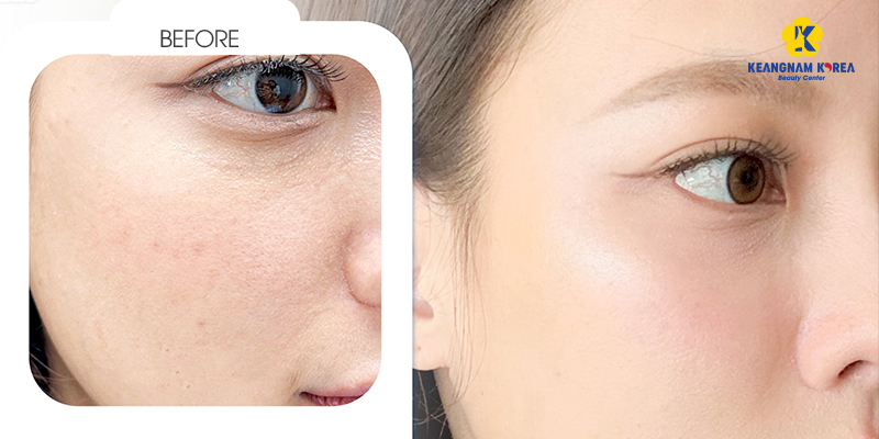 Tiêm Meso trắng da giá bao nhiêu? Hiệu quả có thật sự tốt như lời đồn? 5 Tiêm Meso trắng da giá bao nhiêu?