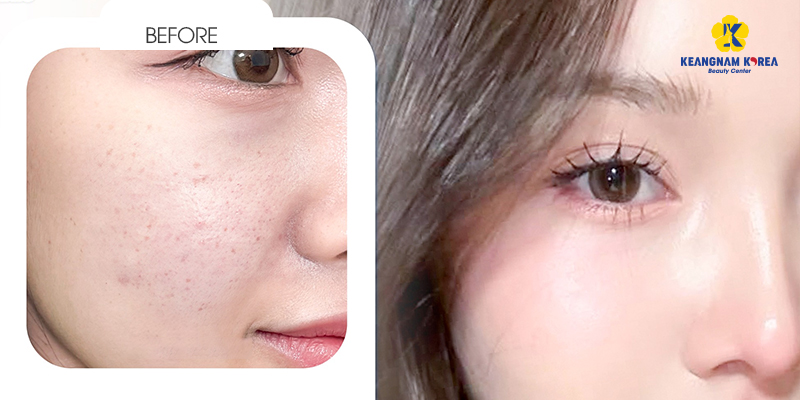 Tiêm Meso trắng da giá bao nhiêu? Hiệu quả có thật sự tốt như lời đồn? 4 Tiêm Meso trắng da giá bao nhiêu?