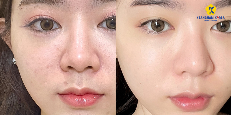 tiêm meso trị mụn giá bao nhiêu