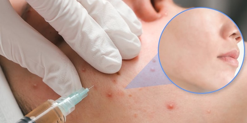 Tiêm meso trị mụn giá bao nhiêu?