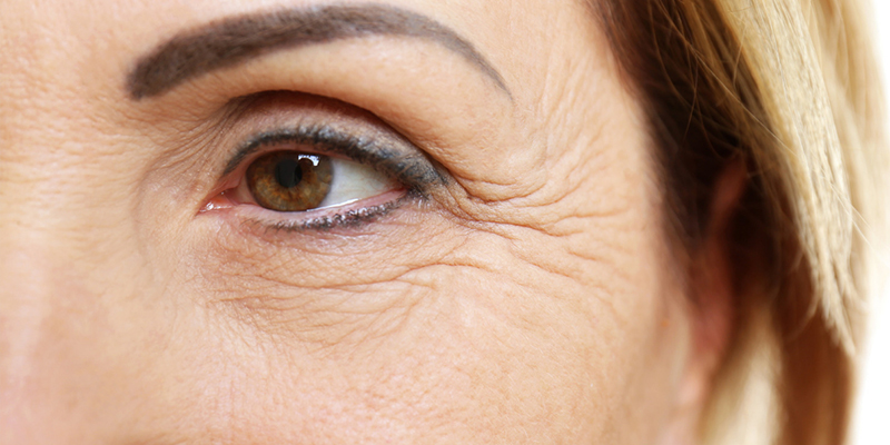 vì sao có nếp nhăn dưới mắt