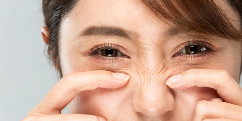 vì sao có nếp nhăn dưới mắt