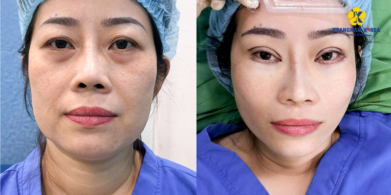 xóa bọng mắt không phẫu thuật