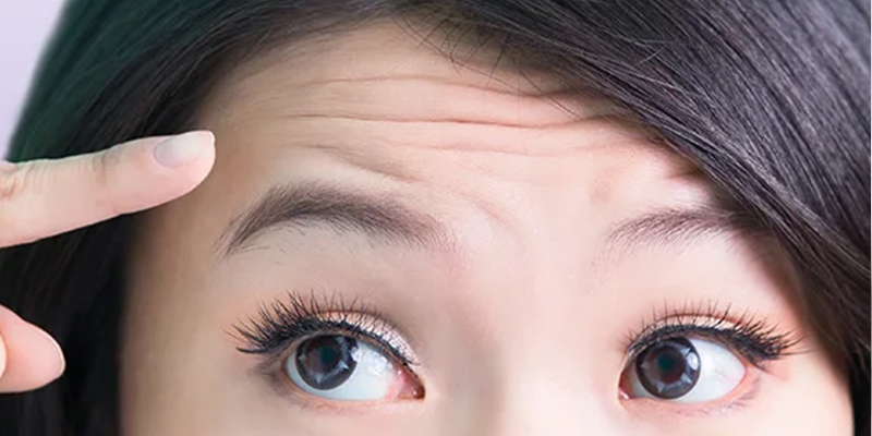 Căng Chỉ Trán Phù Hợp Cho Ai? Chi Phí, Hiệu Quả & Thời Gian Hồi Phục 1 căng chỉ trán