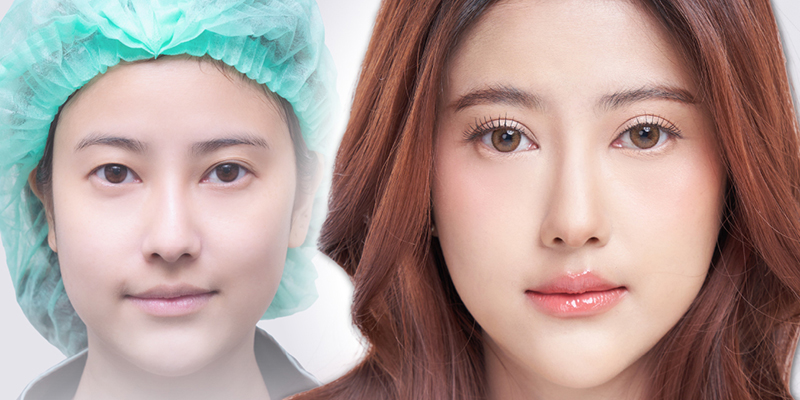 Cắt mí có mấy loại? 5 phương pháp cắt mí hiện đại nhất 1 cắt mí có mấy loại