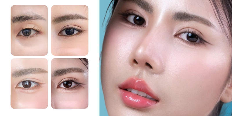 phương pháp nhấn mí