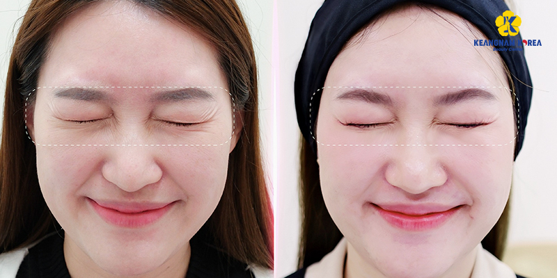 Căng chỉ vùng mắt gồm những phương pháp nào? Giá bao nhiêu? 4 căng chỉ vùng mắt