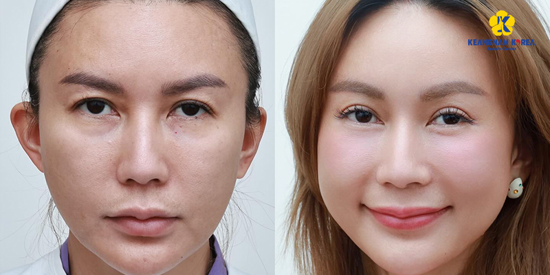 5 cách chăm sóc sau khi nâng cung mày an toàn, hiệu quả nhanh 2 cách chăm sóc sau khi nâng cung mày