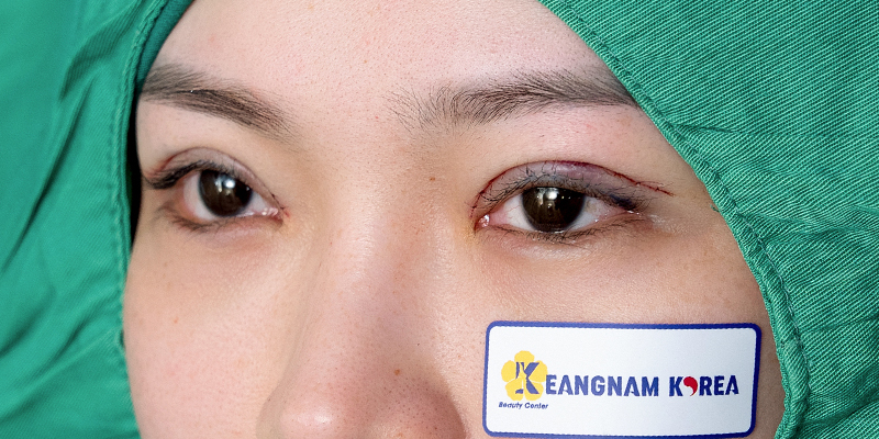 Tổng hợp các cách giảm sưng mắt sau khi cắt mí 1 cách giảm sưng mắt sau khi cắt mí