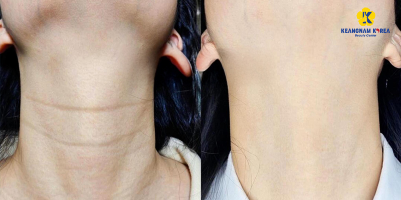 9 cách làm căng da cổ, chống nhăn, chùng nhão tức thì 4 cách làm căng da cổ