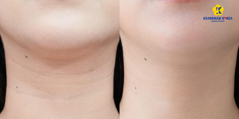 9 cách làm căng da cổ, chống nhăn, chùng nhão tức thì 5 cách làm căng da cổ