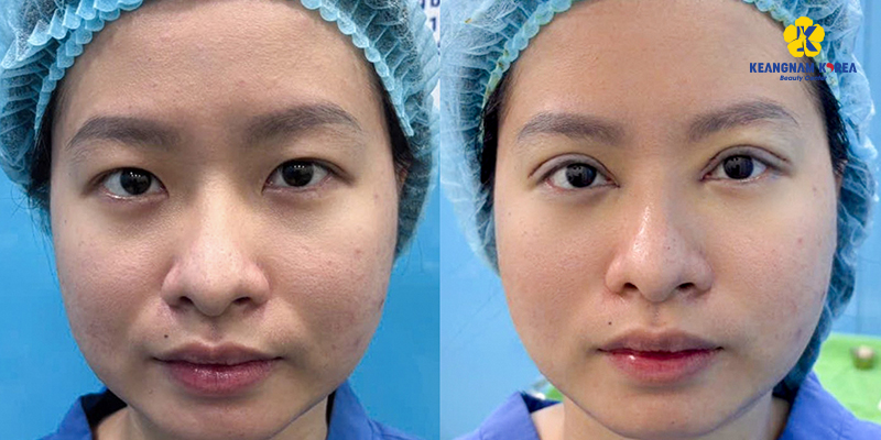 Tổng hợp các cách làm giảm mỡ mí mắt trên tại nhà và spa 4 cách làm giảm mỡ mí mắt trên