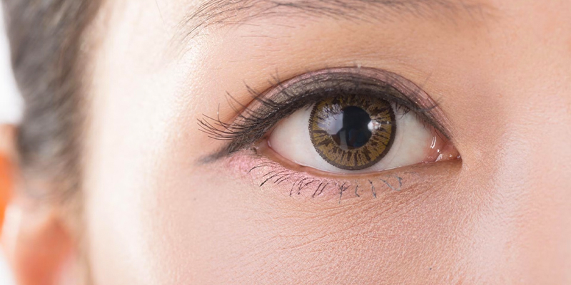 cách làm giảm mỡ mí mắt trên