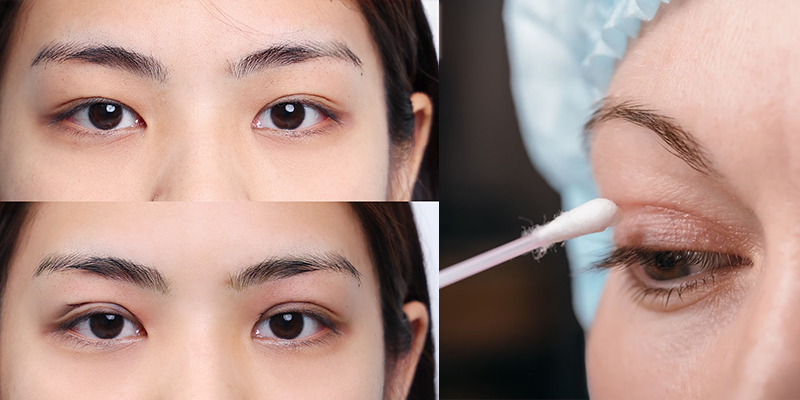8 cách vệ sinh mắt sau khi nhấn mí và các lưu ý quan trọng 1 cách vệ sinh mắt sau khi nhấn mí