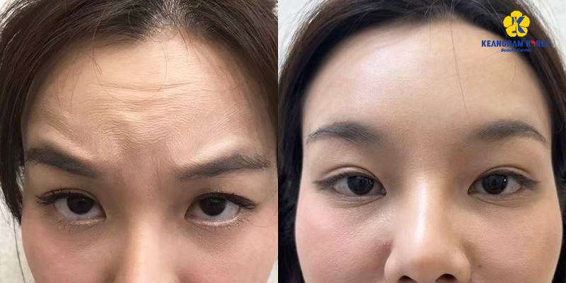 Căng Chỉ Trán Phù Hợp Cho Ai? Chi Phí, Hiệu Quả & Thời Gian Hồi Phục 3 hình ảnh thực tế khi căng chỉ trán