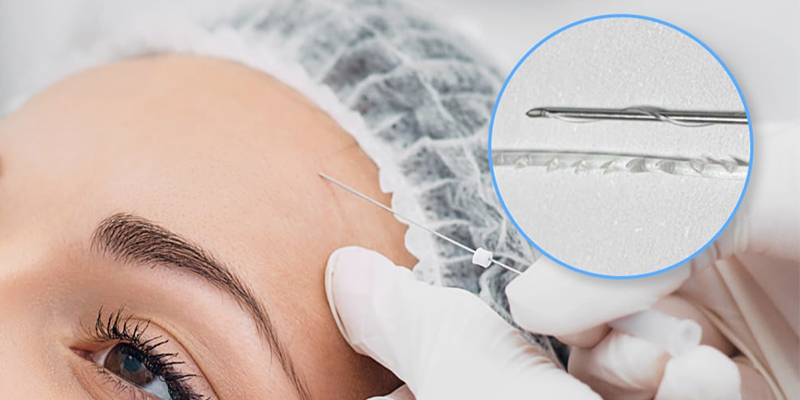 Căng Chỉ Trán Phù Hợp Cho Ai? Chi Phí, Hiệu Quả & Thời Gian Hồi Phục 4 căng chỉ trán ở đâu