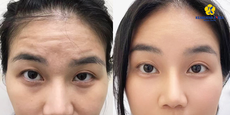 Căng Chỉ Trán Phù Hợp Cho Ai? Chi Phí, Hiệu Quả & Thời Gian Hồi Phục 2 trước và sau căng chỉ trán