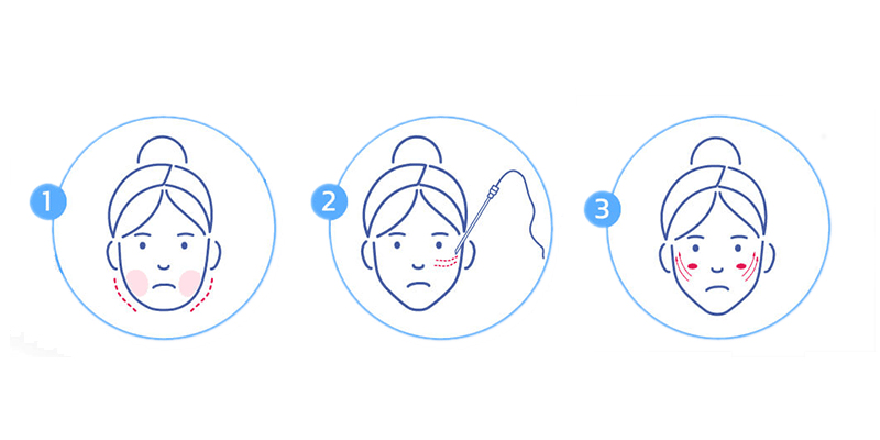 Căng chỉ vùng mắt gồm những phương pháp nào? Giá bao nhiêu? 2 căng chỉ vùng mắt