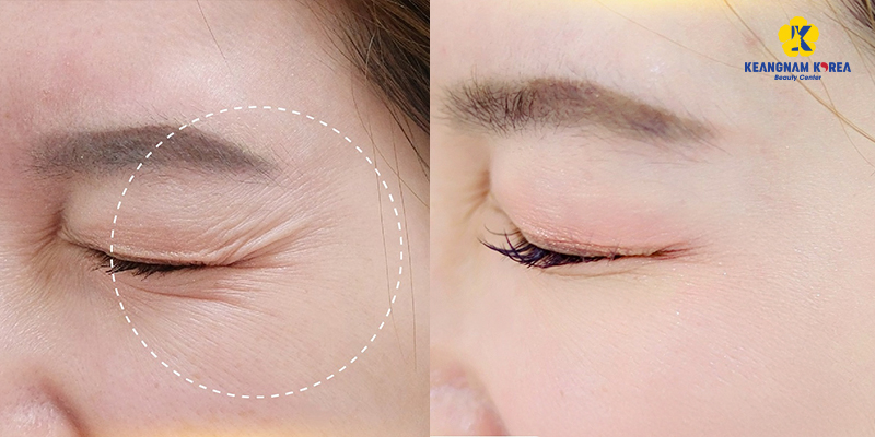 Căng chỉ vùng mắt gồm những phương pháp nào? Giá bao nhiêu? 3 căng chỉ vùng mắt