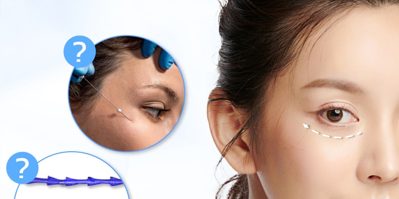 Căng chỉ vùng mắt gồm những phương pháp nào? Giá bao nhiêu? 1 căng chỉ vùng mắt