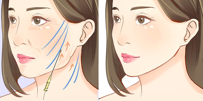 Căng da mặt có đau không? Bao lâu hết đau & hồi phục? Lưu ý trước và sau khi làm là gì? 3 căng da mặt có đau không